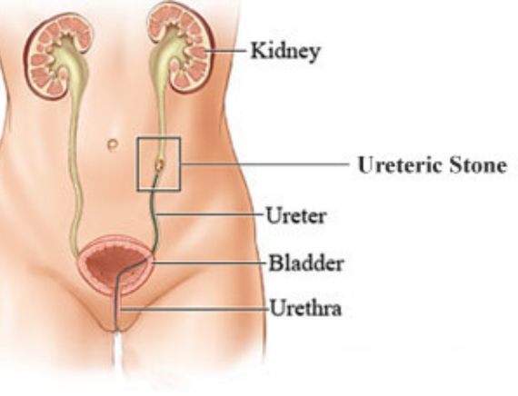 Ureteric