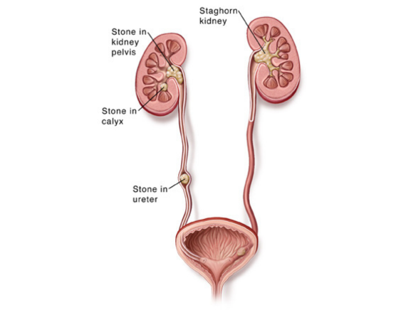 Ureteric1