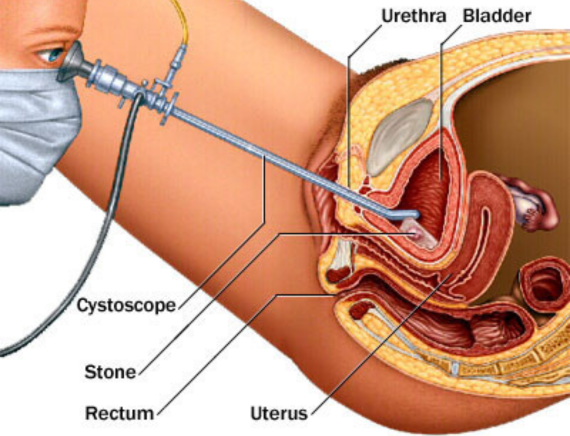 bladder