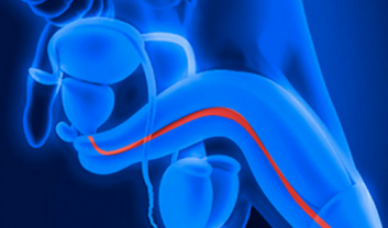 Meatal Stenosis