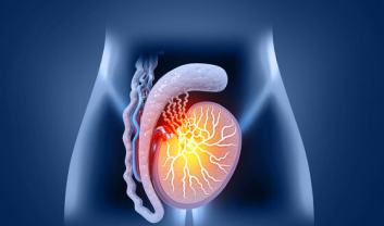 Hydrocele