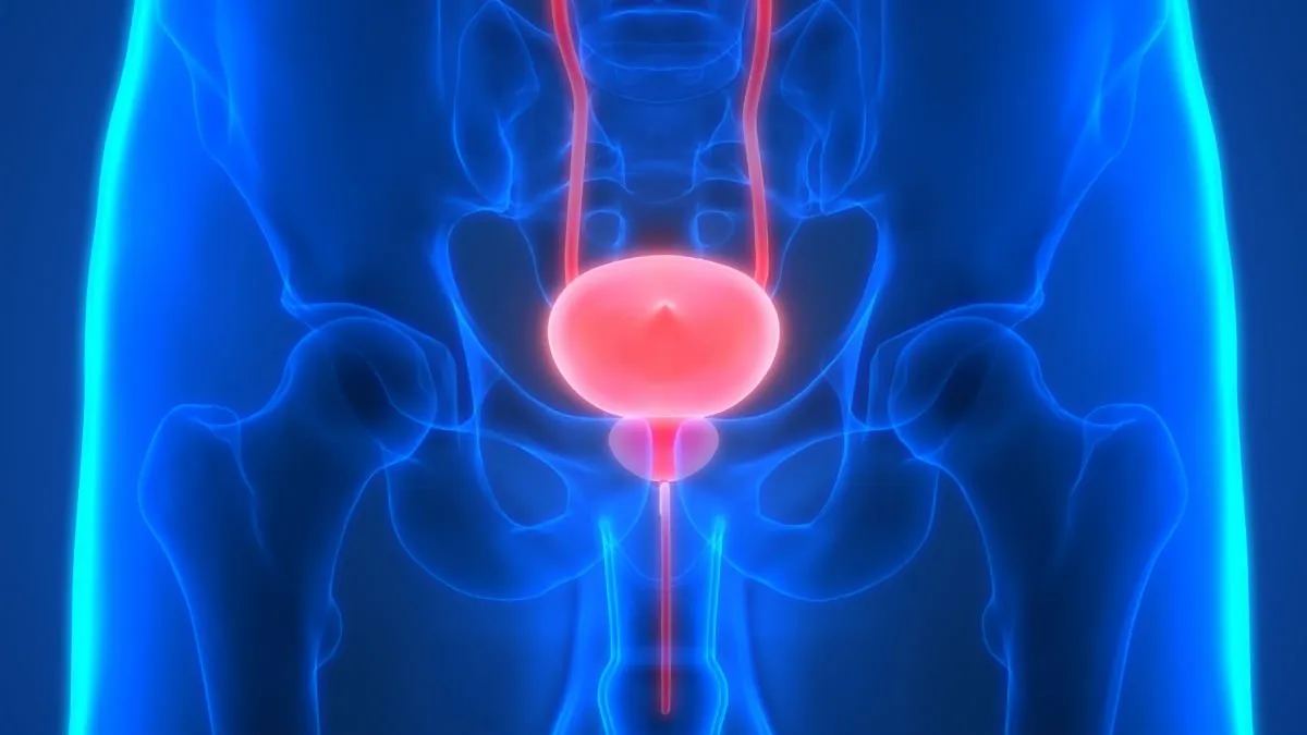 Urinary Bladder Stones