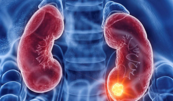 Kidney Cancer