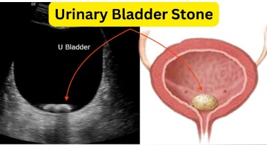 Urinary Bladder Stones Treatment in Sector 41, Noida