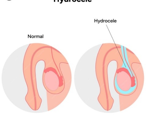 Best Hydrocele Treatment in Preet Vihar