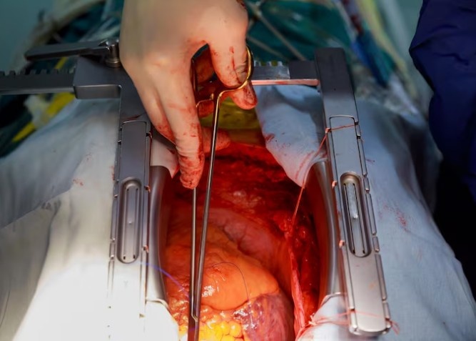 Best Kidney Transplant Surgery in Preet Vihar