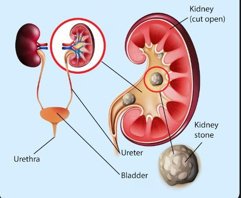 Best Ureteral Stone Treatment in Noida