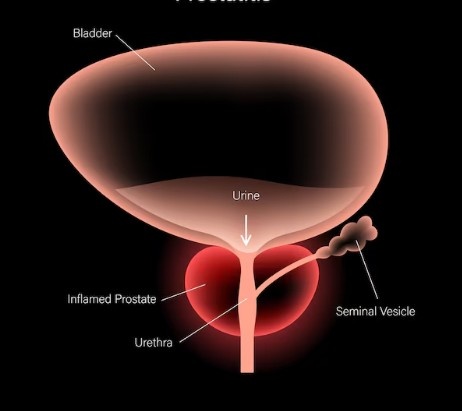 Best Urinary Bladder Stone Treatment in New Delhi