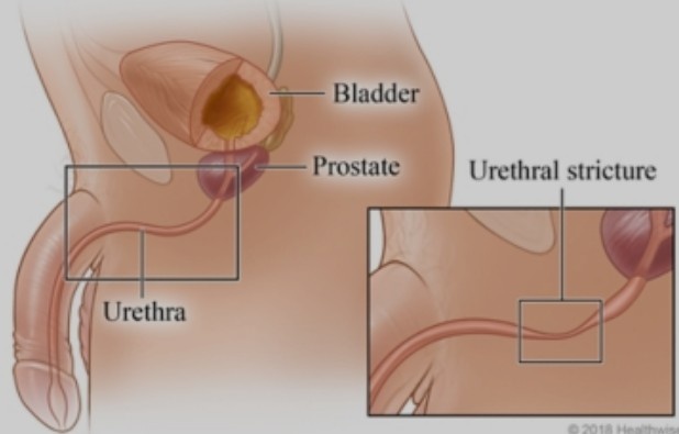 Best Urethral Stricture Treatment in New Delhi
