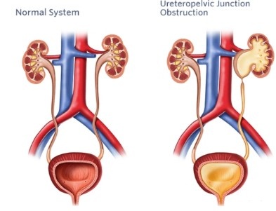 Best PUJ Obstruction Treatment in Laxmi Nagar