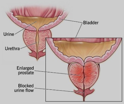 Best Enlarged Prostate Treatment in New Delhi