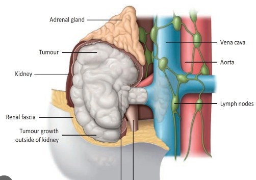 Best Urologist for Kidney Cancer in East Delhi