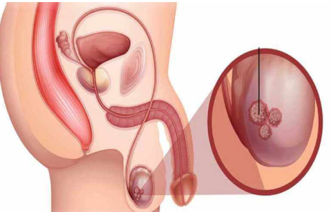 Best Testicular Cancer Doctor in Preet Vihar
