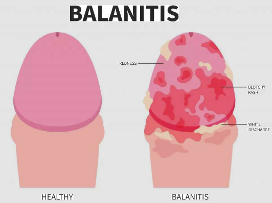 Best Doctors For Balanitis in Sector 50, Noida