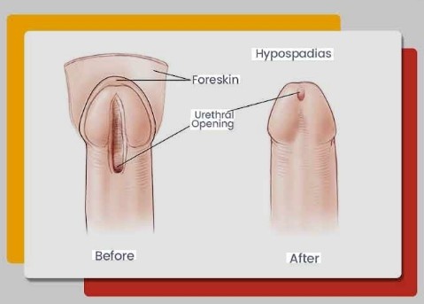 Best Urologist for Hypospadias in Sector 36, Noida