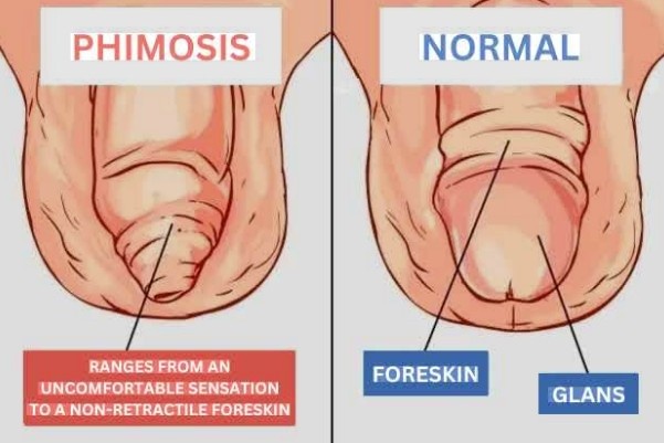 best phimosis treatment in Laxmi Nagar