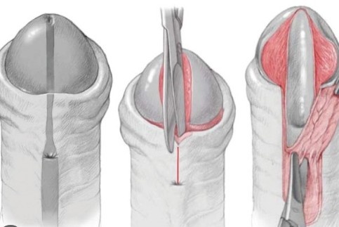 Best Urologist for Meatal stenosis in East Delhi