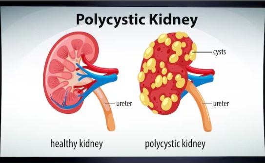 Best Chronic Kidney Disease Treatment in New Delhi
