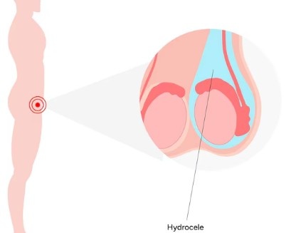 Best Urologist for Hydrocele in Laxmi Nagar
