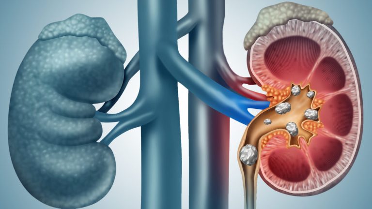 blog-kidneystones-1536x768