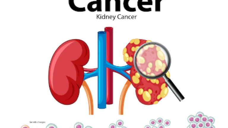 3D diagram of urinary bladder cancer showing tumor growth inside the bladder wall