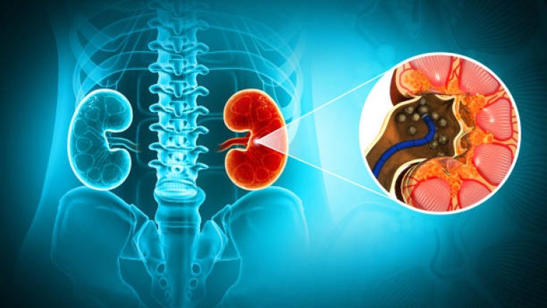 Kidney stone disease. Renal stones. Medical solidarity concept. Kidney stone removing. 3d illustration